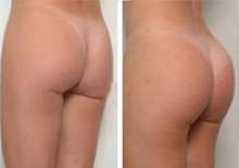 Ten grandes y hermosos gluteos con Glutex