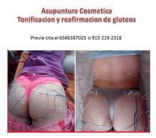 Acupuntura Cosmetica